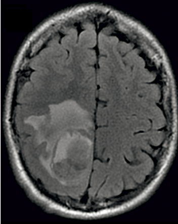 Ryc. 2. Ognisko udaru niedokrwiennego mózgu w prawym płacie potylicznym.