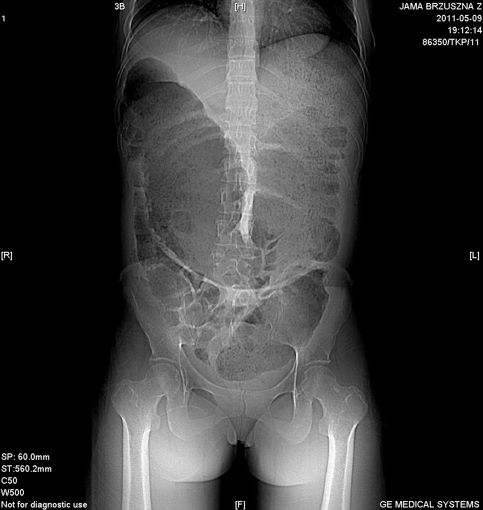 TK jamy brzusznej   uwidoczniono masywne poszerzenie jelita grubego
