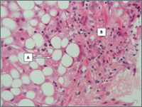 Limfohistiocytoza hemofagocytarna - kiedy nadmierna odpowiedź immunologiczna wymyka się mechanizmom kontrolnym