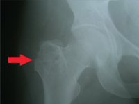 Zastosowanie bioresorbowalnych implantów polilaktydowych w chirurgii ortopedycznej - opis przypadku