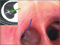 Obustronne guzy płuc - co robić?