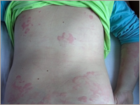 Dziesięcioletnia dziewczynka z gorączką, pokrzywką wielopostaciową oraz bolesnym obrzękiem stawów - opis przypadku