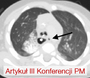 Lewostronna torakoskopia celem usunięcia uchyłka tchawicy i nawrotowej przetoki tchawiczo-przełykowej