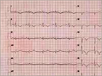 Kardiomiopatia tako-tsubo - nietypowy przypadek starszej chorej