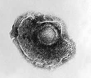 Zespół Ramsaya Hunta oraz zapalenie opon mózgowo-rdzeniowych i mózgu– powikłania  wirusa ospy wietrznej i półpaśca