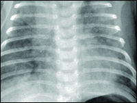 Posocznica gronkowcowa jako stan bezpośredniego zagrożenia życia u dzieci - opis przypadku