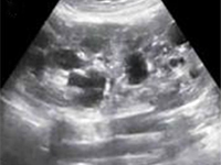 Zespół móżdżkowo-pozapiramidowy jako nietypowa manifestacja zespołu Gitelmana u rodzeństwa