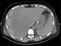 Wykorzystanie Metod Radiologii Inwazyjnej w Leczeniu Pęknięcia Wątroby u Położnicy z Zespołem HELLP