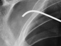 Ciało obce w klatce piersiowej