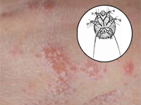 Ciężki przypadek  świerzbu u biorcy przeszczepu nerki mylnie interpretowany jako skórne zmiany alergiczne.