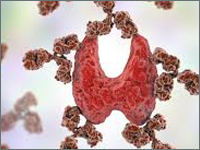 Rzadki przypadek wystąpienia oftalmopatii naciekowej u chorej z wieloletnią niedoczynnością tarczycy w przebiegu choroby Hashimoto