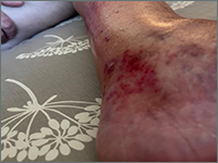 Infekcja stopy cukrzycowej - potrzeba optymalnego leczenia w celu uniknięcia amputacji. Opis przypadku.