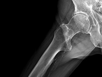 Nawrót pierwotnie niezdiagnozowanej polimialgii reumatycznej (PMR) po 6 latach od wystąpienia pierwszych objawów