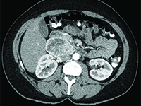 Przyzwojak u 41-letniej kobiety - rzadki nowotwór przestrzeni zaotrzewnowej