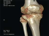 Zastosowanie ortobiologii w leczeniu ubytku kostnego na podstawie przedstawionego przypadku