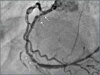 Hemofiltracja i rewaskularyzacja u pacjenta z zespołem sercowo-nerkowym typu 2