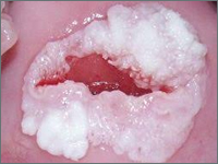 Przypadek infekcji wirusem HPV kobiety oraz jej dziecka urodzonego drogą cięcia cesarskiego