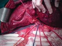 Transplantacja wątroby z powodu nowotworu złośliwego. Hepatoblastoma? Rak wątrobowokomórkowy?