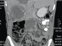 Krwawienie z przerzutu do wątroby u pacjenta z nowotworem jądra