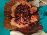 38-letnia pacjentka z gruczolakorakiem torbielowatym wątroby