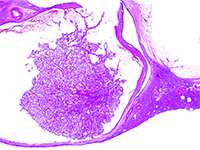 Rak nerki związany z nabytą torbielowatością nerek - nowa jednostka w klasyfikacji WHO 2016.  Opis dwóch przypadków wykrytych na wczesnym etapie rozwoju.