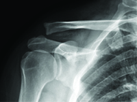 Migracja złamanego drutu Kirchnera po zespoleniu zwichniętego stawu barkowo-obojczykowego – opis przypadku.