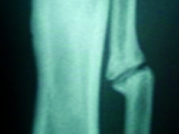 Staw rzekomy w wyniku złamania trzonów kości podudzia u dziecka  – opis przypadku