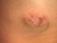 Maska skórna anaplastycznego chłoniaka wielkokomórkowego