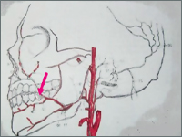 Odma opłucnowa lewostronna jako pierwszy objaw zapalenia śródpiersia
