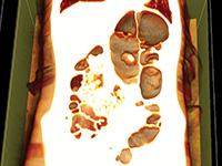 Skręt esicy u nastoletniego pacjenta