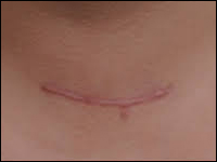 Uszkodzenie przewodu piersiowego jako powikłanie po operacji tarczycy