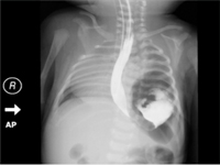 Obustronna wrodzona przepuklina przeponowa - opis przypadku