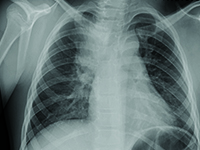 Wrodzona wada układu oddechowego wykryta u 9-letniej dziewczynki  z  zapaleniem płuc