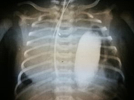 Nawrót przepukliny przeponowej u 21 letniego mężczyzny – opis przypadku.