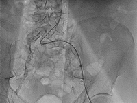 Pacjent z wielonaczyniową chorobą wieńcową i schyłkową niewydolnością nerek leczony wielokrotnymi przezskórnymi interwencjami wieńcowymi.