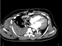 Urazowe uszkodzenie prawego przedsionka i płuca prawego u 24 letniego uczestnika wypadku komunikacyjnego