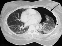 Nawracająca odma opłucnowa w przebiegu mukowiscydozy – trudności terapeutyczne. Opis przypadku.