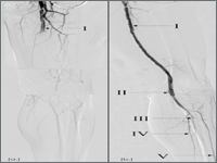 Wewnątrznaczyniowe leczenie ostrego niedokrwienia kończyn dolnych - opis przypadku