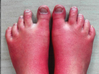 Czy zawsze udaje się ustalić etiologię ostrego zapalenia trzustki? Rzadki przypadek kliniczny OZT u chorej z erytromelalgią pierwotną