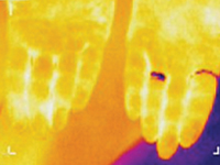 Termosemiotyka przewlekłego zapalenia migdałków