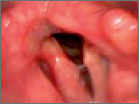 Gruźlica krtani u 64-letniego pacjenta