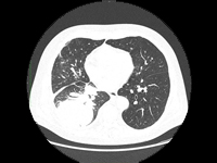 Możliwości leczenia systemowego u chorych na NDRP po przeszczepie narządów - opis przypadku i przegląd literatury