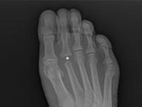 Przykład
 postępowania w przypadku guza II kości śródstopia 
pierwotnie podejrzewanego jako przerzut raka pęcherzykowatego 
tarczycy 40 i 20 lat po całkowitej tyroidektomii