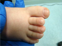 Zespół Rubinsteina i Taybiego współistniejący z narażeniem na czynniki teratogenne - trudności diagnostyczne