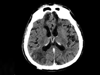 Gdy Twój pacjent śpi za dużo, czyli zaburzenia świadomości u pacjenta geriatrycznego – opis przypadku