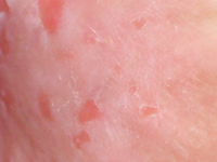 Radykalna radioterapia konformalna w leczeniu nawracającej, pozasutkowej postaci choroby Pageta - opis przypadku.