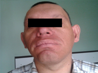 Nietypowy obraz akromegalii u pacjenta z osteochondrodysplazją