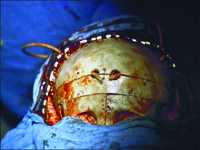 Rozszczepy twarzowo-czaszkowe