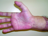 Społeczno - etyczne aspekty transplantacji kończyny górnej