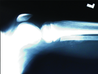 Niezwykły talent, który pojawił się u Piotra Miszczyka leczonego na  mięsakokostniaka złośliwego